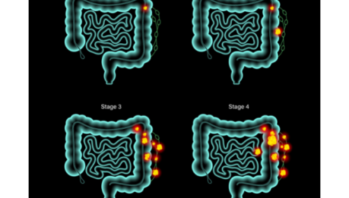 Die Stadieneinteilung bei Darmkrebs
