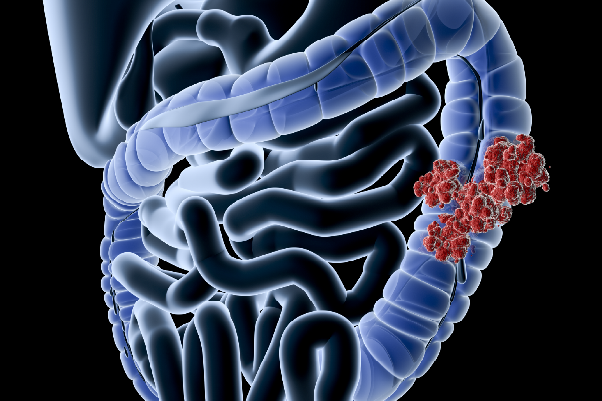 Un collecte d'échantillons de tumeurs colorectaux pour la recherche translationnelle 