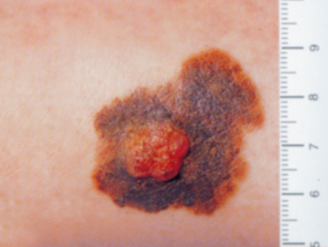 Examen Dépistage - Cancer de la peau