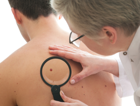 examen dépistage cancer de la peau