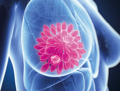 Charakteristische Merkmale des Brustkrebses