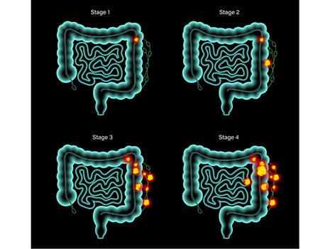 Stages du cancer colorectal 