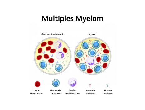 Multiples Myelom
